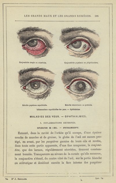 Overfladiske øyebetennelser, oftalmi (fargelitho) av French School