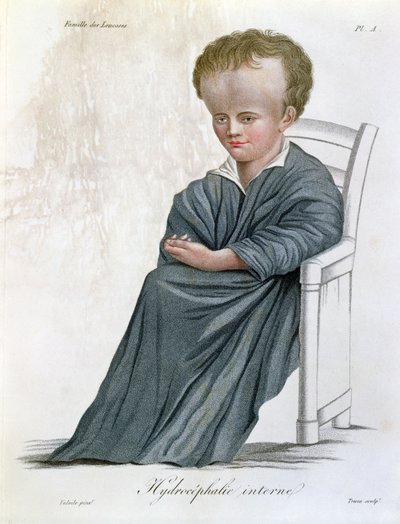 Intern Hydrocephalus, fra Nosologie Naturelle av Baron Jean Louis Alibert (1768-1837) gravert av Tresca, 1817 av French School