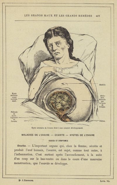 Areolar cyste i høyre eggstokk i full utvikling (farge litho) av French School