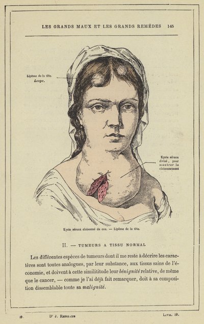 Cloisonne serøs cyste i nakken, Lipoma i hodet (farge litho) av French School