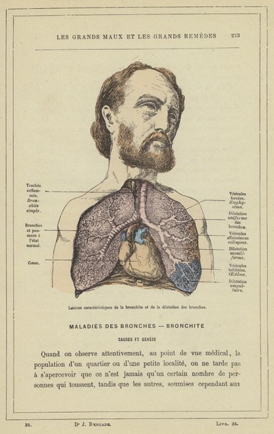 Lesjoner karakteristiske for bronkitt og bronkial dilatasjon (farge litho) av French School