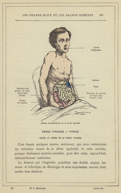 Karakteristiske lesjoner av tyfoidfeber (farge litho) av French School