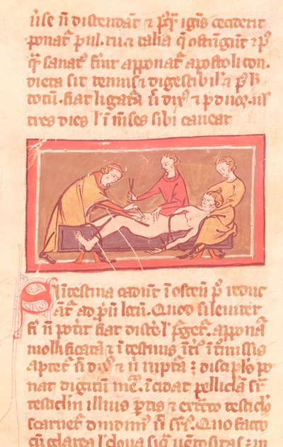 Ms H 89 fol.23 Surgery, fra en utgave av Book of Surgery av Rogier de Salerne av French School