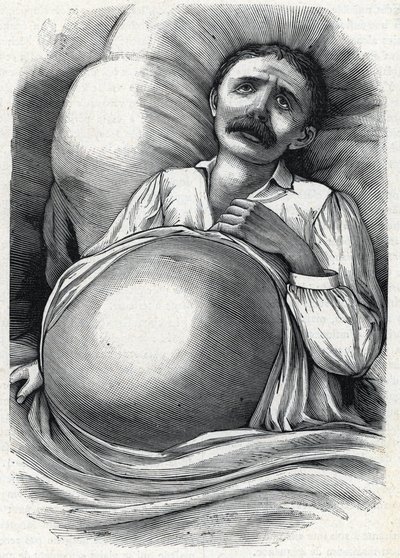Pasient med avansert levercirrhose (gravering) 1888 av French School