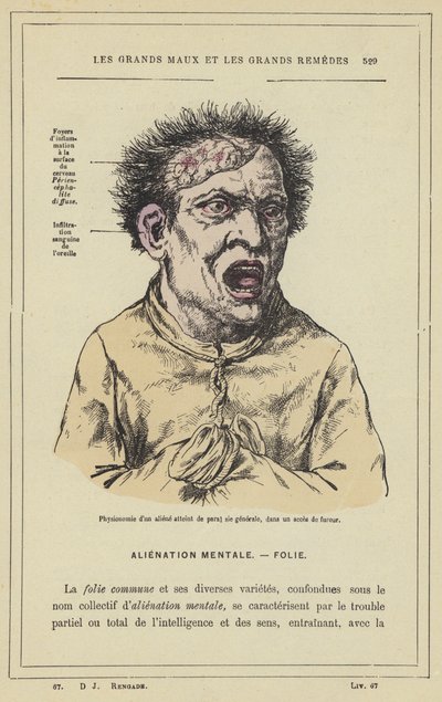 Fysiognomi av en romvesen rammet av paral sie generale, i et rasende anfall (farge litho) av French School