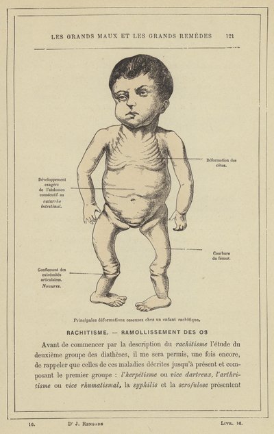 Hovedbeindeformasjoner hos et barn med rakitt (farge litho) av French School