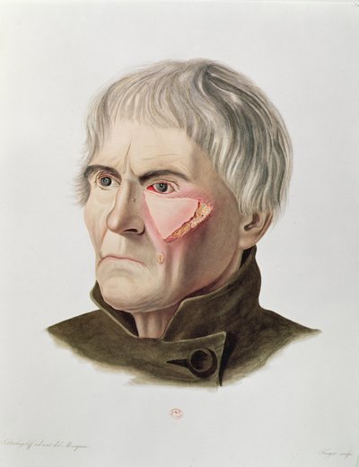Hudtransplantasjonsoperasjon, fra Selecta Praxis Medico-Chirurgica av Alexander Auvert, Paris, 1856 av French School