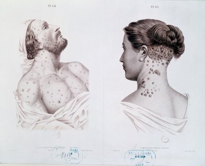 Symptomer på syfilis hos menn og kvinner, fra en medisinsk bok, ca. 1850-60 av French School
