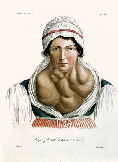 Skjoldbruskkjertelsykdom, fra en bok av Baron Jean Louis Alibert (1768-1837) 1817 av French School