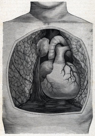 aneurismeruptur (gravering) 1888 av French School
