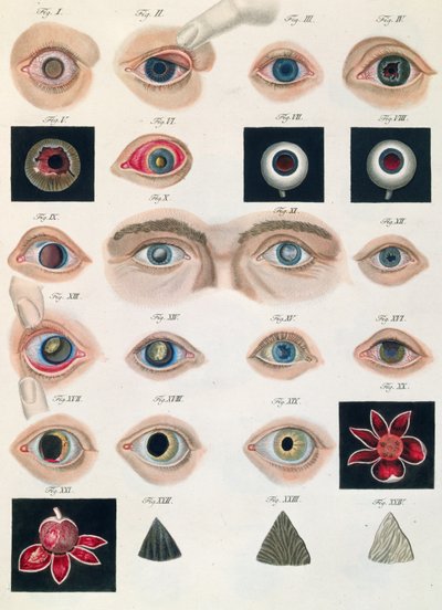 Beskrivelse av medfødte øyeanomalier, fra kliniske presentasjoner av sykdommer og visuelle defekter i det menneskelige øyet, av Friedrich August von Ammon (1799-1861) 1838 av German School