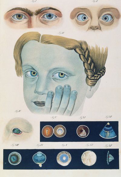 Beskrivelse av medfødte øyeanomalier, fra kliniske presentasjoner av sykdommer og visuelle defekter i det menneskelige øyet, av Friedrich August von Ammon (1799-1861) 1838 av German School
