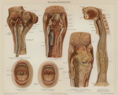 Sykdommer i halsen (farge litho) av German School