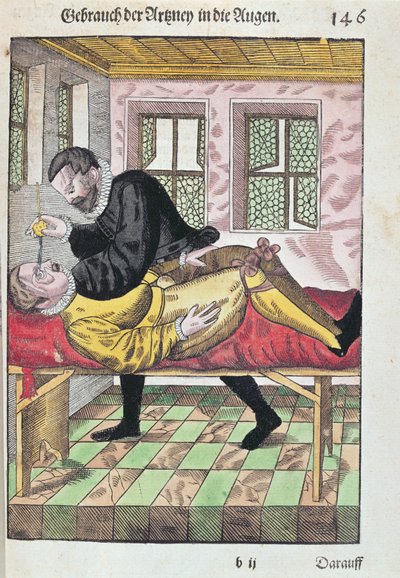 Eye Operation, fra Ophthalmodouleia av Georg Bartisch (1535-1636) utgitt i Dresden i 1583 (farget treblokktrykk) av German School