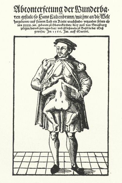 Hans Kaltenbrunn og hans uutviklede sammenflettede tvilling (gravering) av German School