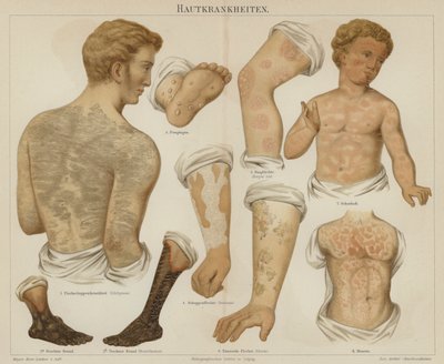 Hudlidelser (farge litho) av German School