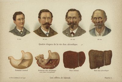 Effektene av alkoholmisbruk (farge litho) av German School