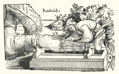 Behandling av et brukket ben (gravering) av German School