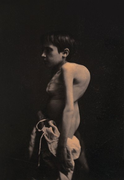 Portrett av en pukkelgutt, ca. 1855-57 av Guillaume-Benjamin-Armand Duchenne de Boulogne