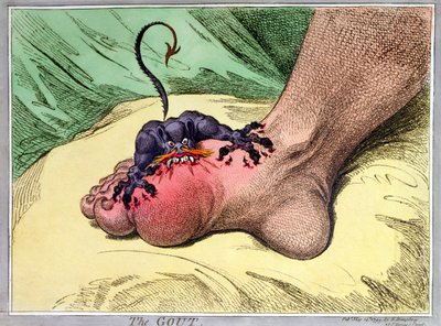 The Gout, utgitt av Hannah Humphrey i 1799 (håndfarget myk grunnetsing) av James Gillray