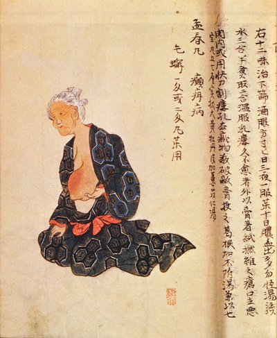 Den første kirurgiske behandlingen av brystkreft utført under generell anestesi av Seishu Hanaoka (1760-1836) i 1804 av Japanese School