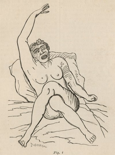 Hysterisk epilepsi, angrep, vridninger, fig. 1 fra 