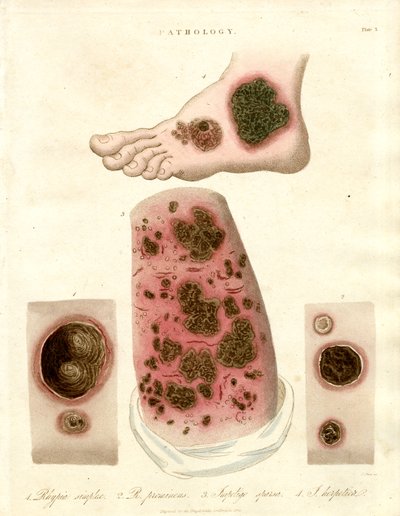 Patologiske hudsykdommer - Pityria, impetigo og syfilis av John Pass