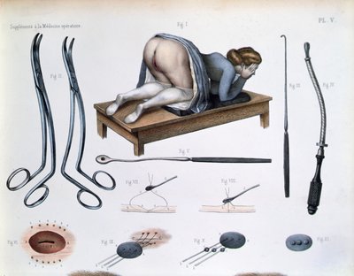 En operasjon på en vesikovaginal fistel, plate fra 