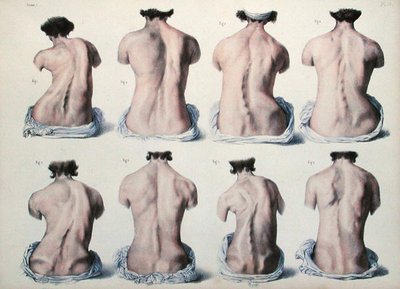 Spinal deformiteter, plate fra 