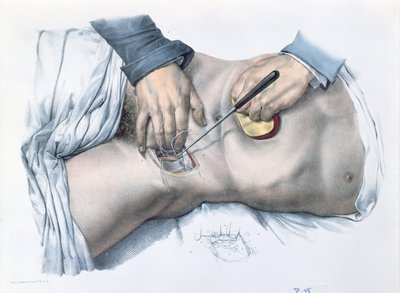Fester en arterie, tallerken fra 