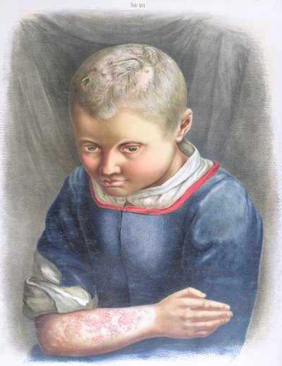 Favus, fra en bok av Daniel Cornelius Danielssen (1815-94) 1892 av Norwegian School
