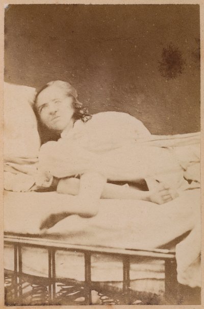 Hysterisk epilepsi, forvrengninger, plate XXXVIII fra 