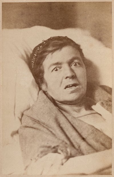 Hysterisk epilepsi, ansiktskontraksjon, plate VIII fra 'Iconographie Photographique de La Salpetriere' av Bourneville og P. Regnard, Paris, 1876 (albumtrykk) av Paul Regnard