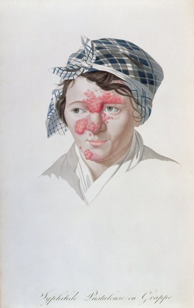 Syfiliske klyngepustler, fra en bok av Baron Jean Louis Alibert (1768-1837) 1838 av Salvadore Tresca