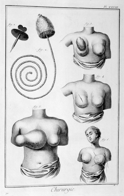 Brystkirurgi, 1751-1777 av Unbekannt