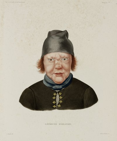 Sykdommer, spedalskhet Spedalsk kvinne, Island, tidlig på 1800-tallet av Unbekannt