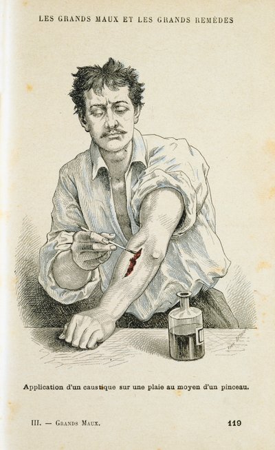 Male et sår med en antiseptisk løsning, c1890 av Unbekannt