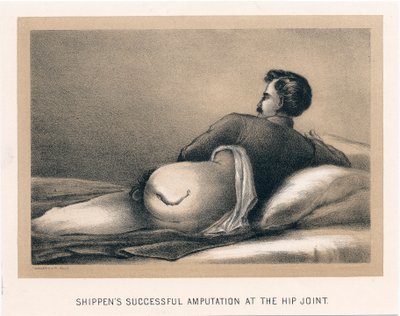Sender vellykket amputasjon ved hofteleddet, amerikansk borgerkrig, 1865 av Unbekannt