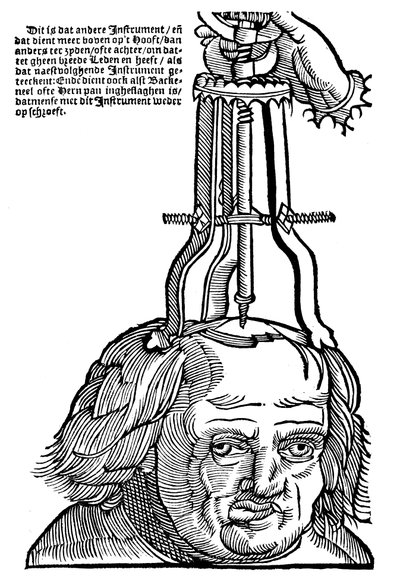 Trephination, 1593 av Unbekannt