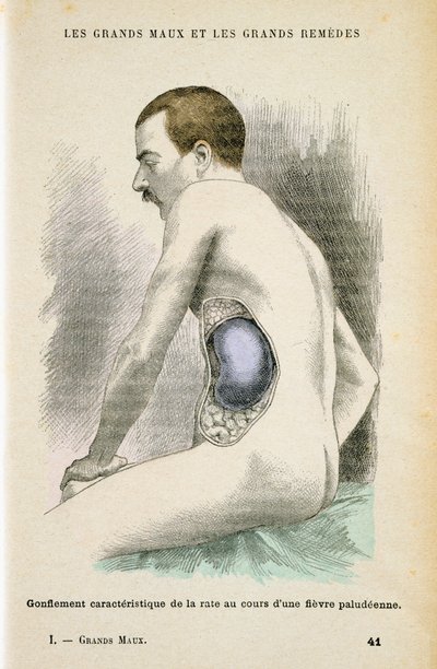 Typisk forstørret milt hos en malariapasient, c1890 av Unbekannt