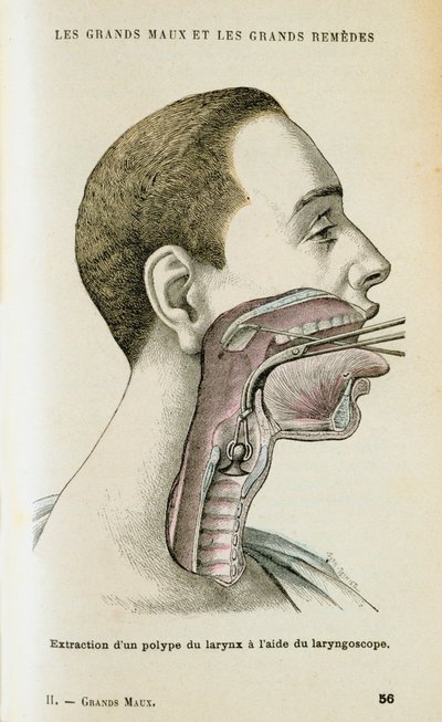 Bruke et laryngoskop for å hjelpe til med å fjerne en polypp fra halsen, c1890 av Unbekannt