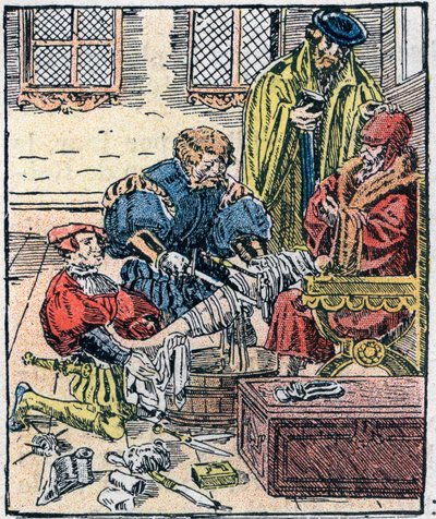 Amputasjon av et ben på 1500-tallet. av Unknown artist