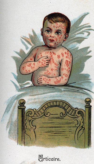 Barnesykdommer: Elveblest. I "Den nye naturmedisinen"" av F.E. Bilz. av Unknown artist