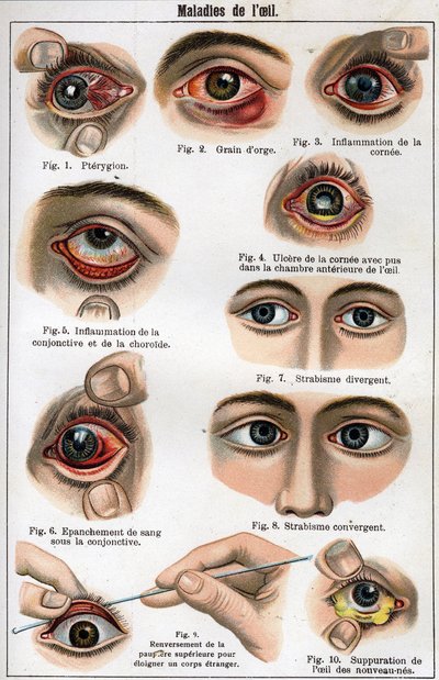 Diseases of the Eye. “The new natural medicine” by F.E. Bilz. av Unknown artist