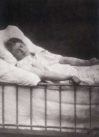 Hystero Epilepsie - Stivkrampeangrep i "" Fotografisk ikonografi av Salpétrière: service of Mr. Charcot"" av Paul Regnard og Bourneville av Unknown artist