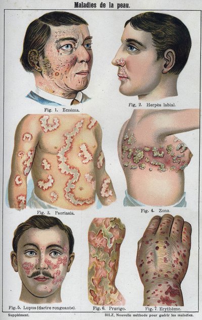 Skin diseases: Eczema, labial herpes, psoriasis, shingles, lapus (rotting darter), prurigo, erytheme.” The new natural medication”” by F.E. Bilz. av Unknown artist