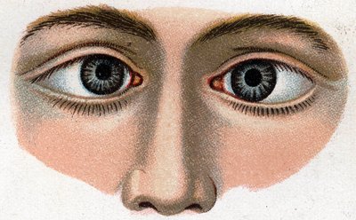 Strabismus konvergerer. "Den nye naturlige medisinen" av F.E. Bilz. av Unknown artist