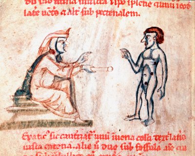 Legen brenner pasienten på smertefulle områder med varme strykejern Miniatyr fra manuskriptet " "De Medicina cauteriorum secundum Brunum, Rugerius et Rolthe" 1200-tallets Paris, BN av Unknown artist