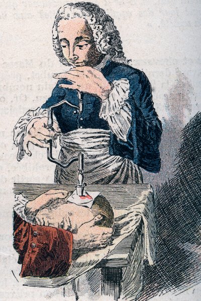 Trepanasjonen. 1700-tallstrykk. av Unknown artist
