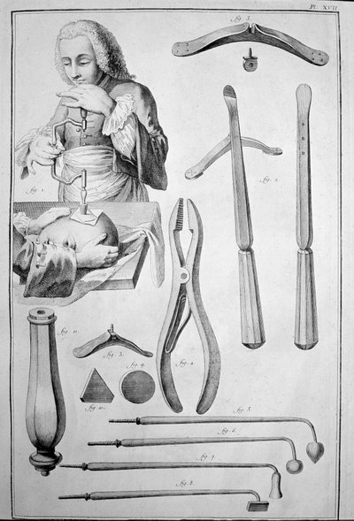 Trepanering av hodeskallen, forskjellige instrumenter (gravering av Unknown artist